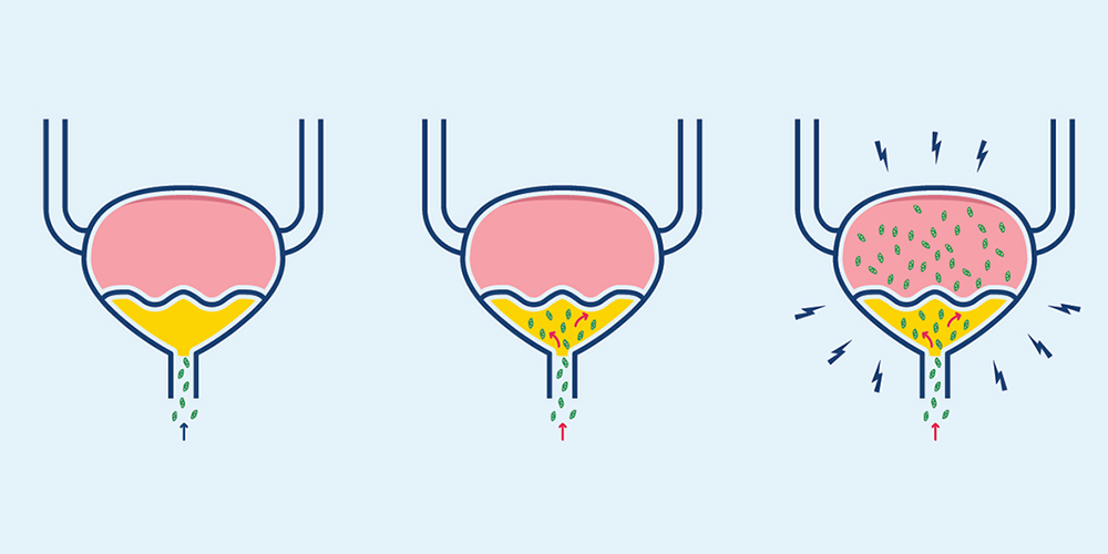 Illustration of how bacteria infect the bladder in a urinary tract infection Illustration of how bacteria infect the bladder in a urinary tract infection